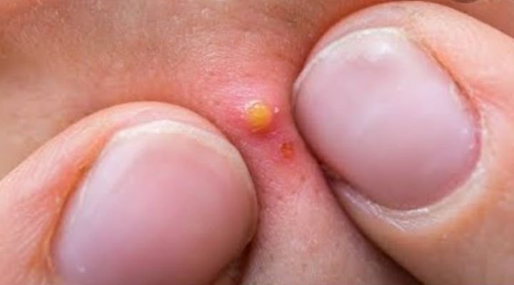 Acne: Tratamento Natural Poderoso para Eliminar Acne