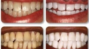 Clareamento Dental Caseiro: Uma Receita Simples e Eficaz